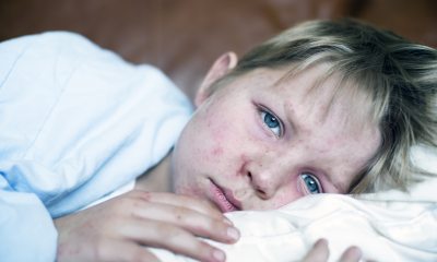 School aged white child sick with measles rash lying in bed